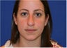 Rhinoplasty