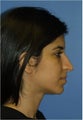 Rhinoplasty