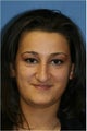 Rhinoplasty