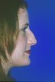 Rhinoplasty