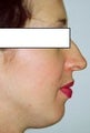 Rhinoplasty
