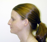 Rhinoplasty