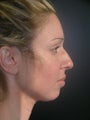 Rhinoplasty