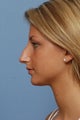 Rhinoplasty