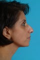Rhinoplasty