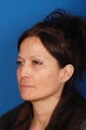 Rhinoplasty