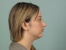 Rhinoplasty
