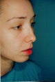 Rhinoplasty