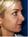 Rhinoplasty