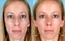 Rhinoplasty