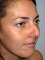 Rhinoplasty