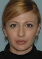 Rhinoplasty
