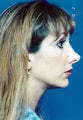 Rhinoplasty