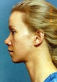 Rhinoplasty