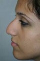 Rhinoplasty