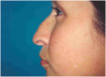 Rhinoplasty