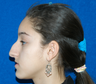 Rhinoplasty