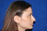 Rhinoplasty