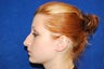 Rhinoplasty