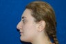 Rhinoplasty