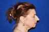 Rhinoplasty