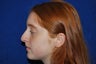 Rhinoplasty