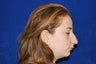 Rhinoplasty