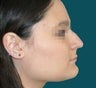 Rhinoplasty
