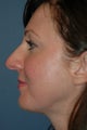 Rhinoplasty