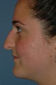 Rhinoplasty