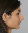 Rhinoplasty