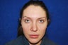Female Rhinoplasty (Nose Job)