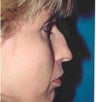 Rhinoplasty