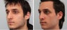Primary Rhinoplasty