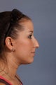 Rhinoplasty