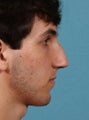Rhinoplasty