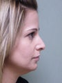 Rhinoplasty