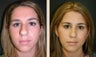 Rhinoplasty
