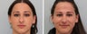 Primary Rhinoplasty