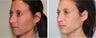 Before and After Rhinoplasty - 2 weeks post op