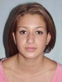 Rhinoplasty