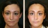 Rhinoplasty