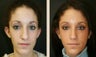 Rhinoplasty