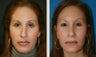 Rhinoplasty