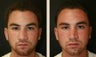 Rhinoplasty