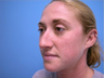 Rhinoplasty
