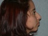Rhinoplasty