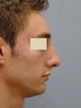 Rhinoplasty