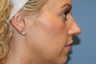 Rhinoplasty