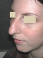 Rhinoplasty